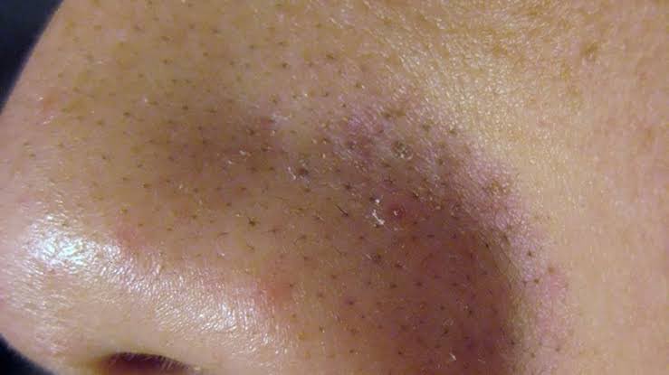 echopwt_'s tweet photo. สิวเสี้ยน ไม่ใช่ สิว‼️
มันคือ sebaceous filaments เป็นสิ่งปกติ เป็นทางลำเลียง sebum ออกมาที่รูขุมขน

คุมได้ด้วย BHA อย่าง salicylic acid
ไม่ควรใช้แผ่นลอกสิวเสี้ยน จะทำให้รูขุมขนกว้างกว่าเดิม https://t.co/VweUotAk3Q