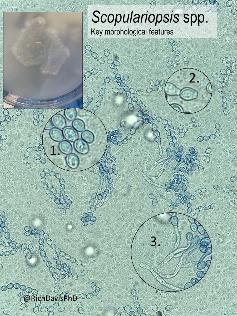 richdavisphd's tweet photo. #MicroRounds (Day 875): At first glance, a tech called the left mold Penicillium. It's a lookalike, but it's actually Scopulariopsis.
This isolate shows 3 key Scopulariopsis features (but not 1 fun one) that can help identify this mold.
What are they? #ASMClinMicro #IDTwitter https://t.co/rHGM7jrwDW