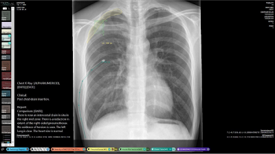 Radiology_AI's tweet photo. CANDID-PTX dataset: 19,237 chest x-rays with annotations for pneumothorax, acute rib fractures, & chest tubes https://t.co/zXWc0g3YCR @AucklandUni @SijingF @SouthernDHB #ptx #pneumothorax #ribFx https://t.co/GnHKM88LOi