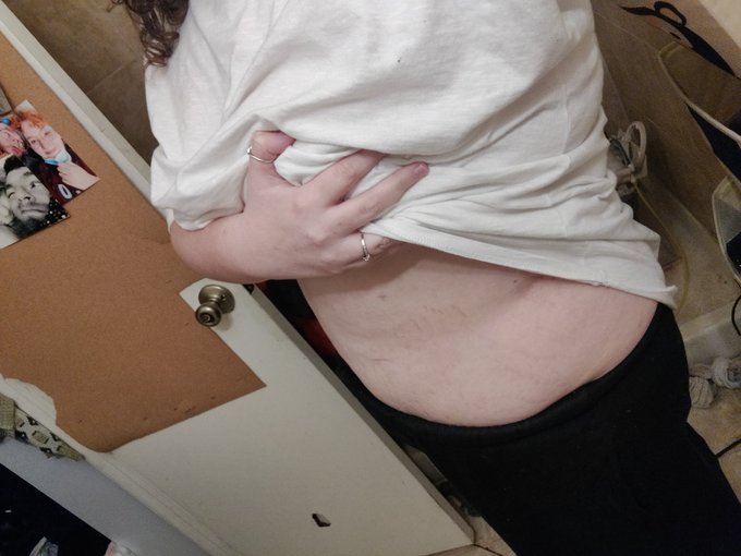 2 months post op and I'm down over 60 pounds https://t.co/rmewynZueR