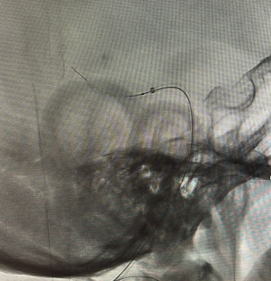 Rapid__Medical's tweet photo. Treated by Drs. Guillaume Marie and Steven Hajdu, from CHUV | Department of diagnostic and interventional radiology in Lausanne, Switzerland. Thank you for sharing your excellent work! #NeverTooFar #DISTAL #DISTALS #Tiger13 https://t.co/ATIXz8Smdt