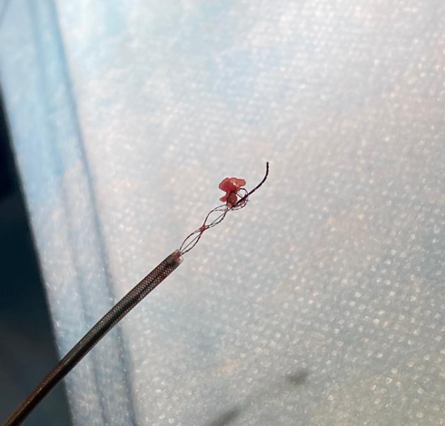 Rapid__Medical's tweet photo. Distal PCA P2/P3 of a 39 year old patient, #FirstPass #TICI3 treated with #Tigertriever13 + Aspiration with recanalization in only 15 minutes after puncture. https://t.co/reF6YiJ1wU