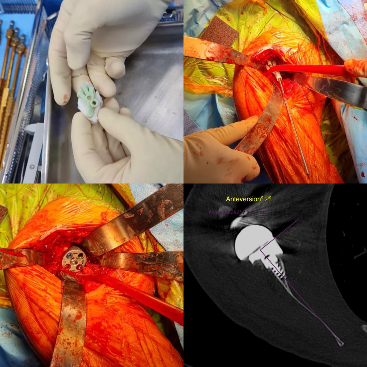 Copper3D_Chile (@copper3d_chile) on Twitter photo Primera cirugía de prótesis reversa de hombro realizada en <a href="/Clinicaalemana/">Clínica Alemana</a> donde se utiliza la tecnología de impresión 3D SLA antimicrobial (#Glaciarys), realizada por el Dr. Francisco Ruiz y guía quirúrgica diseñada por Diego Godoy, Biomedical Designer de Copper3D. Primera cirugía de prótesis reversa de hombro realizada en <a href="/Clinicaalemana/">Clínica Alemana</a> donde se utiliza la tecnología de impresión 3D SLA antimicrobial (#Glaciarys), realizada por el Dr. Francisco Ruiz y guía quirúrgica diseñada por Diego Godoy, Biomedical Designer de Copper3D.
