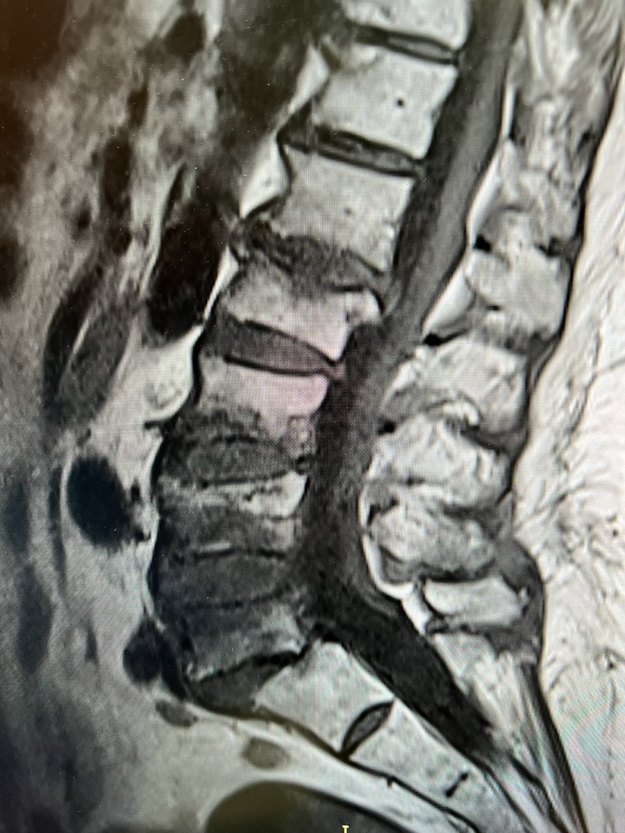 dougbeall's tweet photo. 7 fractures and the patient was told there’s nothing that can be done surgically. How about #vertebralaugmentation ?? One of the very few things in medicine that is demonstrably life-saving and life-prolonging. This lack of education is seriously harming our patients @ASBMR https://t.co/jNLeImzzt8