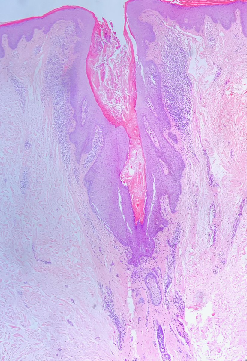JHoDermPath's tweet photo. Monomorphic itchy papules in axillae of female
-Dilated follicle with parakeratotic plug
-Infundibular spongiosis
-Perifollicular lymphohistiocytic infiltrate (foamy histiocytes may be seen)
-Subjacent dilated apocrine glands
Fox-Fordyce Disease!🦊
#pathtwitter #dermpath https://t.co/d13yTiqLMk