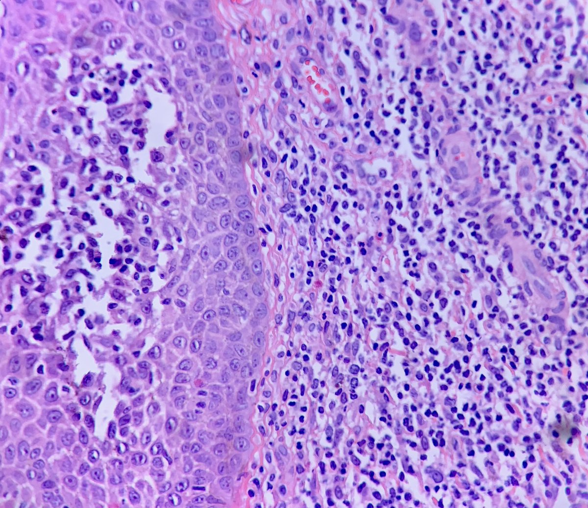 JHoDermPath's tweet photo. Monomorphic itchy papules in axillae of female
-Dilated follicle with parakeratotic plug
-Infundibular spongiosis
-Perifollicular lymphohistiocytic infiltrate (foamy histiocytes may be seen)
-Subjacent dilated apocrine glands
Fox-Fordyce Disease!🦊
#pathtwitter #dermpath https://t.co/d13yTiqLMk