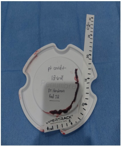PenNeuro's tweet image. US HCPs: Large clot burden removed with #RED72 by Dr. Julian Hardman out of @DesertRadiology . #REDGlideDifference. Rx only. For risk info: bit.ly/37YcYIU. Clinical results may vary.