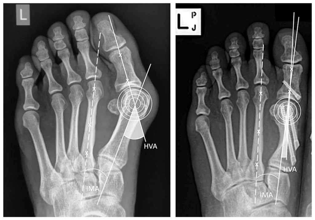 Percutaneous surgery for severe hallux valgus deformity can achieve a large deformity correction, patient satisfaction, and quality of life with reasonable rates of residual deformity and low rates of recurrence. ow.ly/cauV50HnTTi