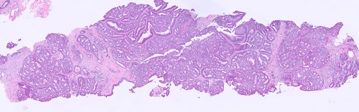kis_lorand's tweet photo. 1/ A #breastpath case for the New Year 😁...BIRADS 3 lesion...additional images in the thread 👇 https://t.co/3eIg7Hrihx
