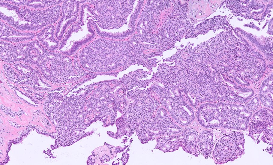 kis_lorand's tweet photo. 1/ A #breastpath case for the New Year 😁...BIRADS 3 lesion...additional images in the thread 👇 https://t.co/3eIg7Hrihx