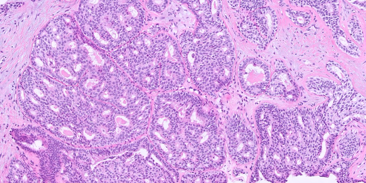 kis_lorand's tweet photo. 1/ A #breastpath case for the New Year 😁...BIRADS 3 lesion...additional images in the thread 👇 https://t.co/3eIg7Hrihx
