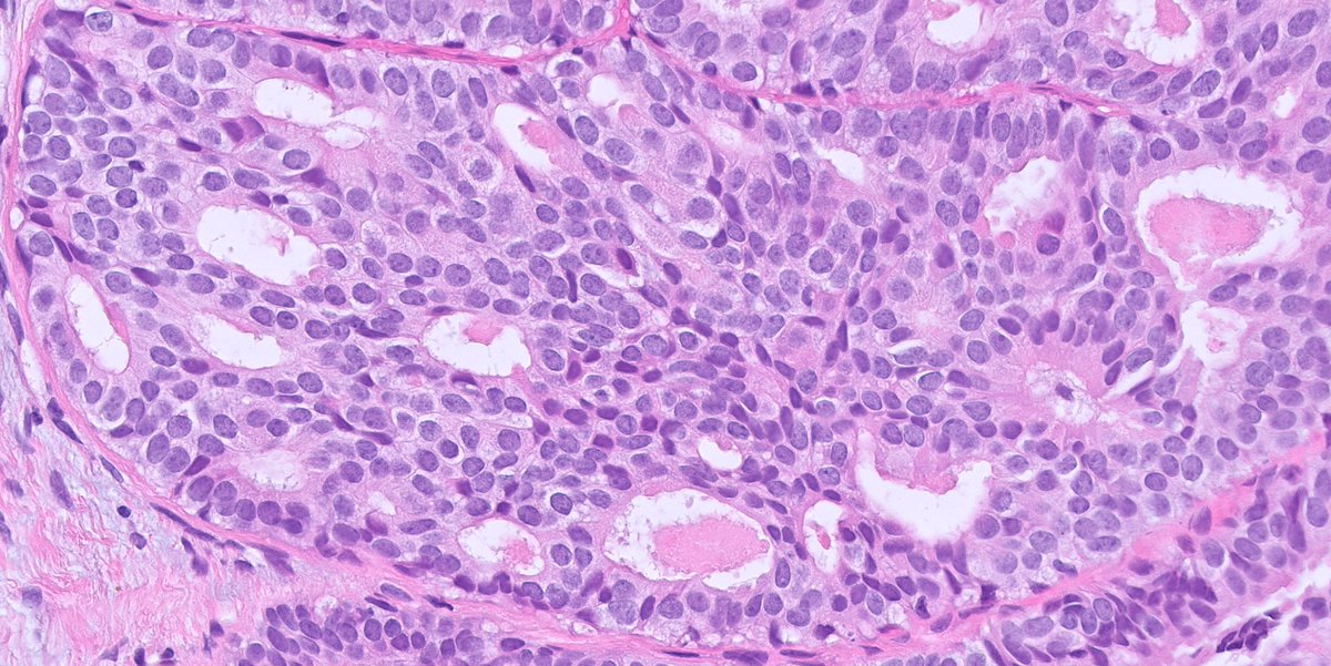 kis_lorand's tweet photo. 1/ A #breastpath case for the New Year 😁...BIRADS 3 lesion...additional images in the thread 👇 https://t.co/3eIg7Hrihx