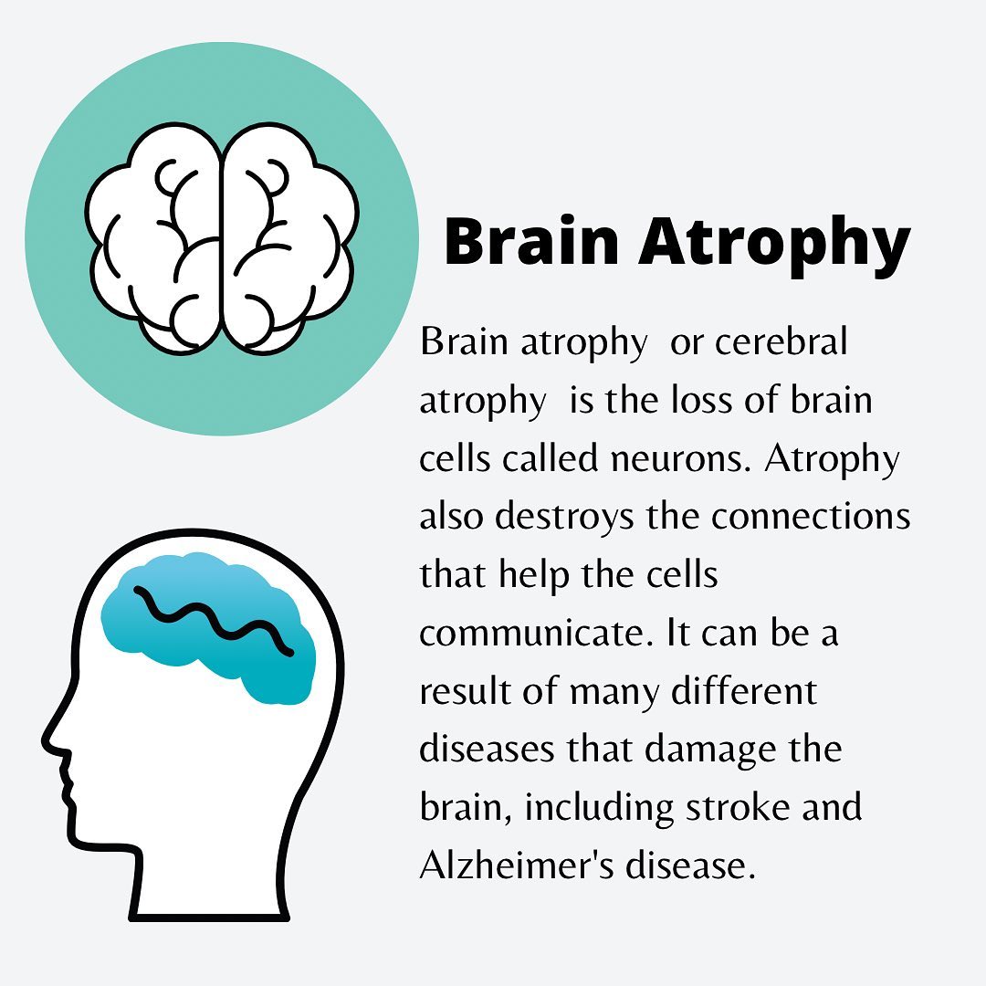 WeSpeakScience's tweet photo. Brain atrophy, or cerebral atrophy, is a condition in which the brain or regions of the brain literally shrink in size. It ranges in severity, the extent of which determines its impact.

#brain #brainatrophy #medicine #doctor #alzheimers #stroke #memory #health #old #neurons https://t.co/qAPgNqd9mk