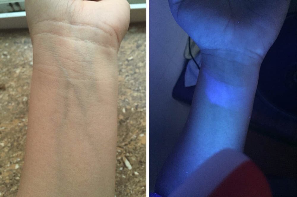 Лампа вуду витилиго. Свечение в лучах лампы вуда. Витилиго свечение в лампе вуда. Витилиго под лампой вуда. Кожа лица под ультрафиолетом.