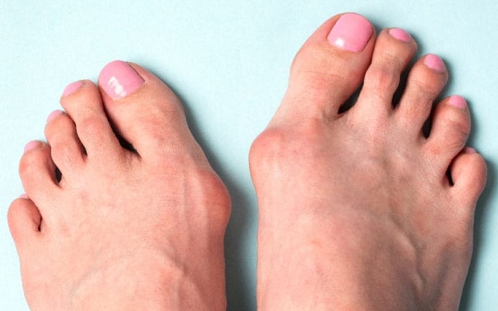 DrJPElton's tweet photo. Here are the steps you can take to ease bunion pain. 

https://t.co/wS7NHqleo9

#bunionpain #bunions #FootDoctor #FootPain #sportsmedince  #orthopedics #colorado https://t.co/6dMISktxLb