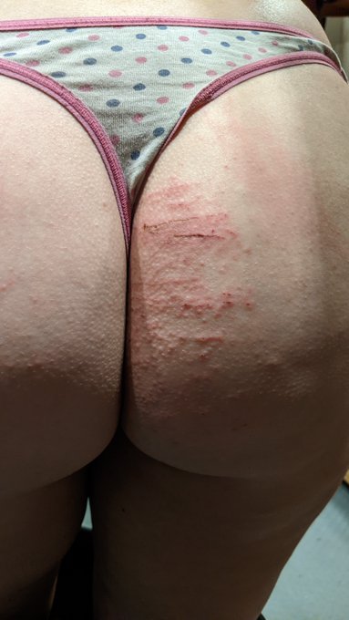 I fell drunkenly down a hill (naked) and scraped up my butt really really bad haha. Omg so painful.  How