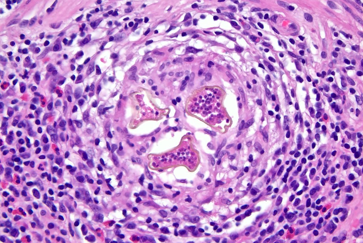 Looking for ideas as to what this, incidental finding in the submucosa of a colon polyp, any thoughts?

#PathTwitter