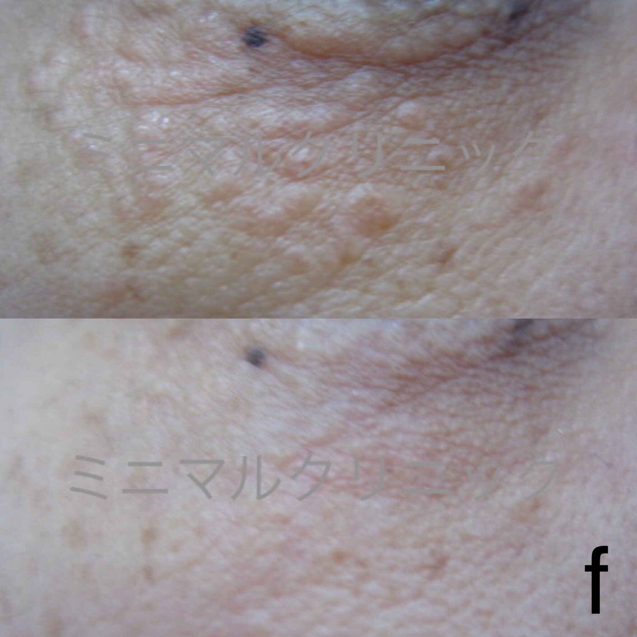 稗粒腫 Twitter Search Twitter