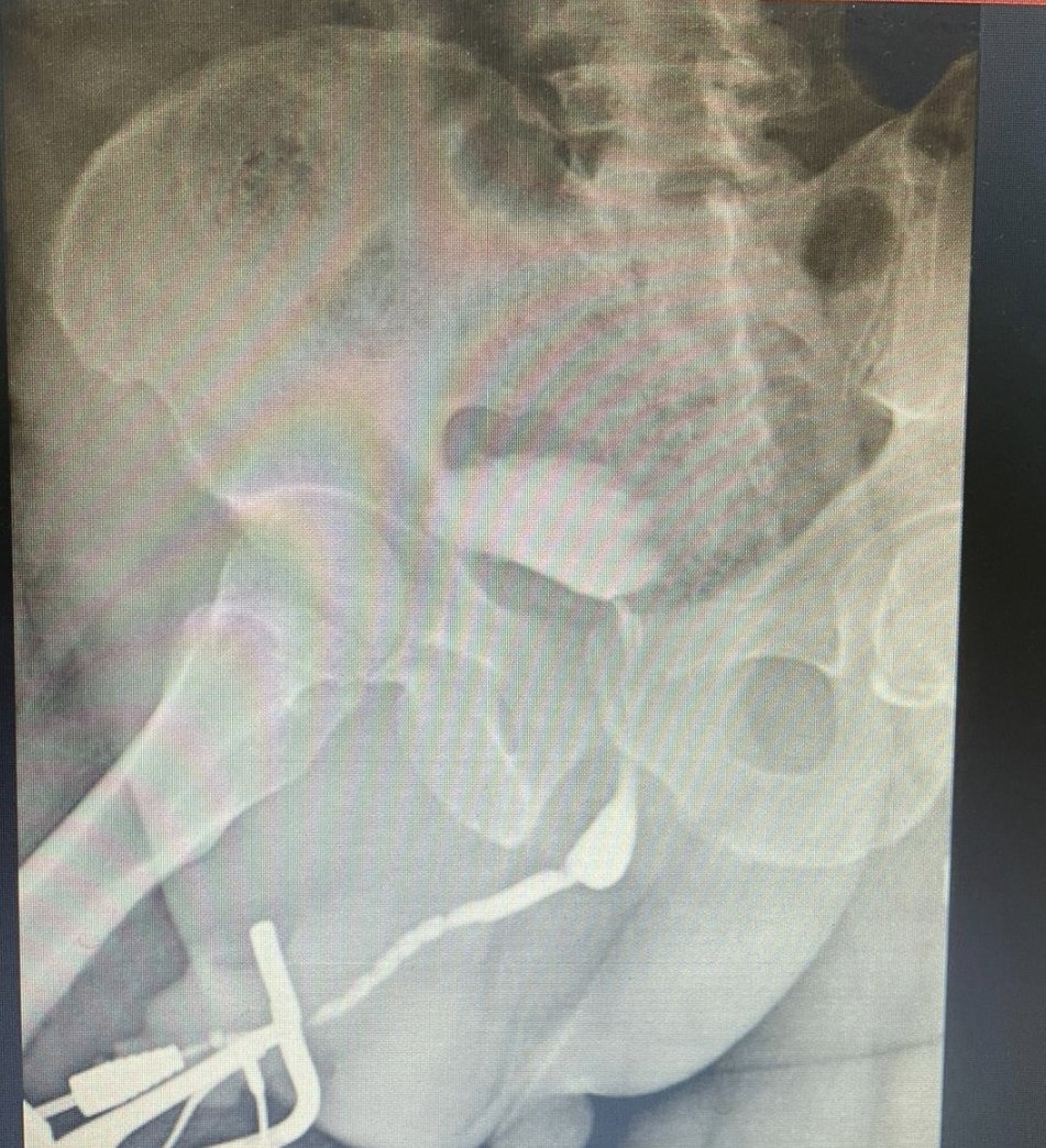 قمنا ولله الحمد 
🔴 بإجراء عملية معقدة لاصلاح ضيق مجرى البول بطول ١٢ سم
🔴 خرج المريض من المستشفى بعد < 24h 
🔴 كل الشكر لوحدة المسالك البولية <a href="/aladan_hospital/">مستشفى العدان</a> 
والشكر موصول للزملاء والأخوان الاعزاء <a href="/OTBuro/">Dr. Khaled Alotaibi</a> <a href="/Bo_Sha3ban/">Abdullah Abdullatif</a> 
#صوت_الطبيب
#تجمع_أطباء_العالم