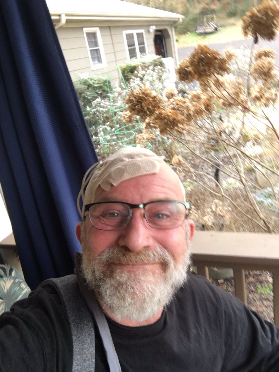 BenJammin1968's tweet photo. Fighting GBM brain π§ cancer wearing #optune to battle this nasty shit. #alwaysgrateful #neverwithouthope https://t.co/CxlbGbNKlK