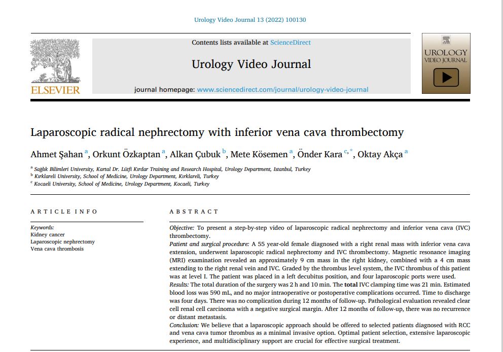Hot of the press,  The special issue about #Renal Malignancies <a href="/urovidjournal/">Urology Video Journal (UVJ)</a>.

Our new video article is showing step-by-step pure #laparoscopic radical #nephrectomy with #venacava #thrombectomy for cT3b #kidneycancer.

Open video article:
sciencedirect.com/science/articl…
