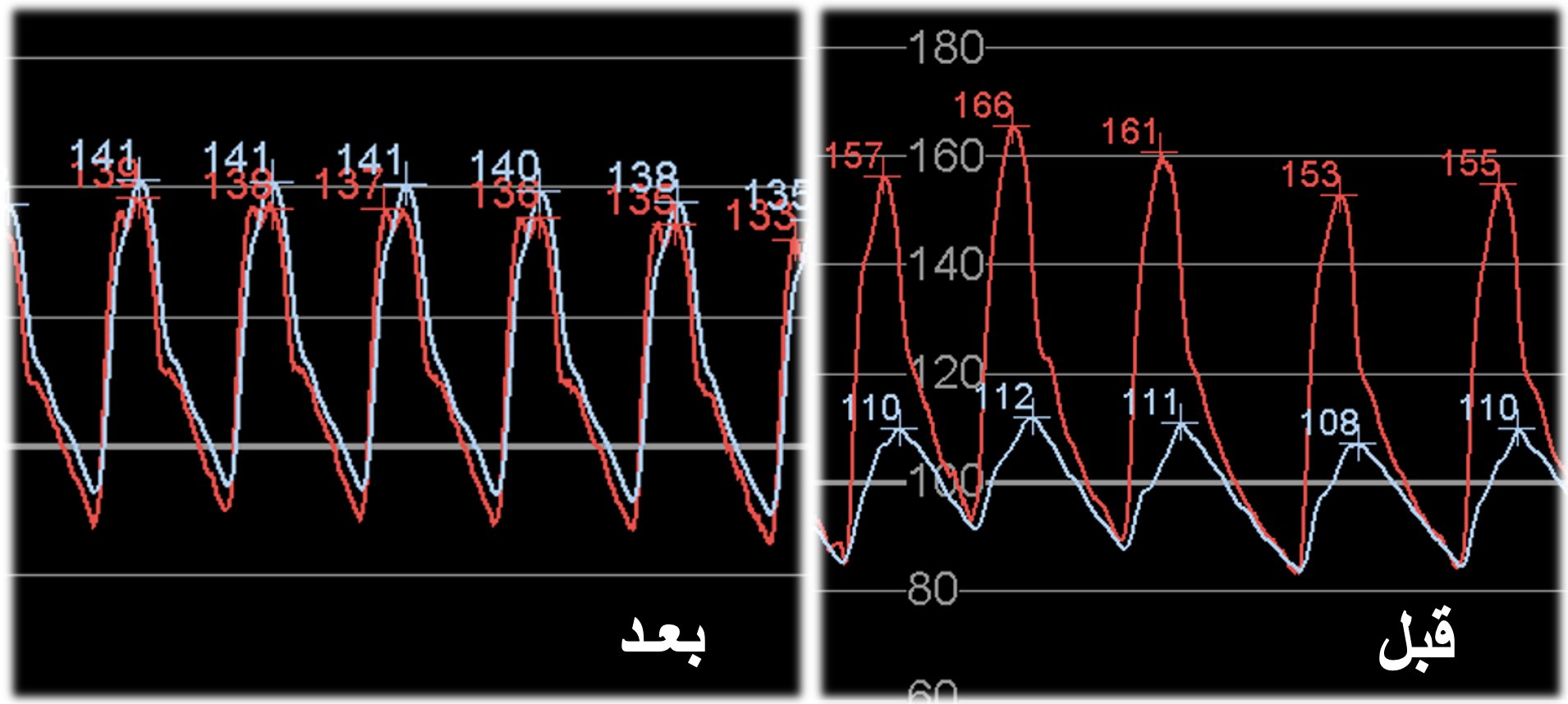 اضطراب النبض يدل على