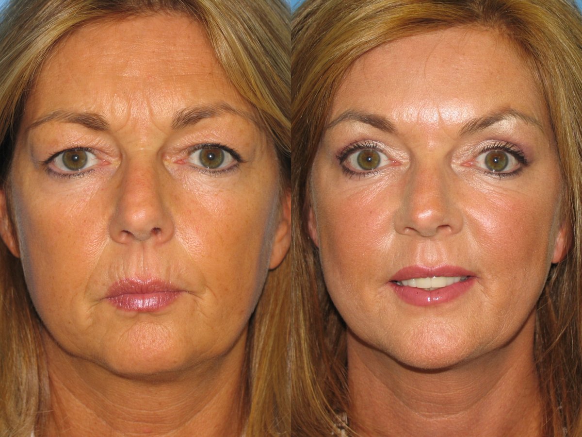 LoVermeBoston's tweet photo. Wrinkles appear as we grow “wiser”. While aging is an honor, fine lines and wrinkles can be unwelcoming. Discover why wrinkles happen, how to prevent, and ways to lessen them once they start appearing. #botox #Wrinkles #finelinesandwrinkles
https://t.co/s5XxaYgeoE https://t.co/H3FHitkVhO