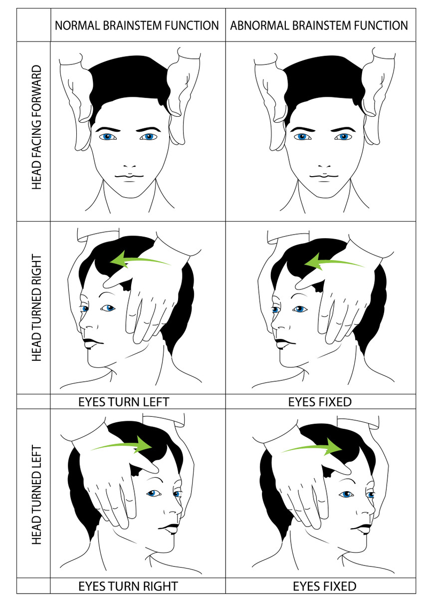 EMCoachLLC's tweet photo. Easy points on the #EmergencyMedicine #InTrainingExam if they ask: the oculocephalic reflex. #EMPearls #EMC4ITE https://t.co/BHtyUBjwCf