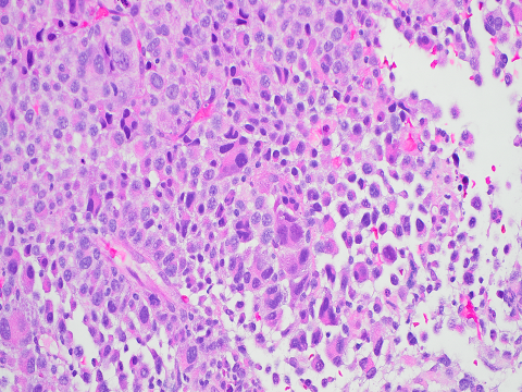 SibaElHussein's tweet photo. Example of plasma cell neoplam, megakaryocytoid variant #hemepath #mmsm #pathtwitter https://t.co/d1enV5CeEB