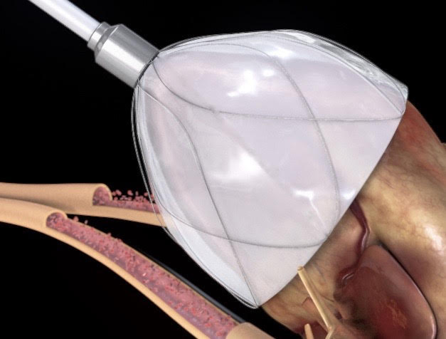 CorInnova named a Top Healthcare Startup by AngelMD - 2021 Competition Winners newswire.com/news/angelmd-a…