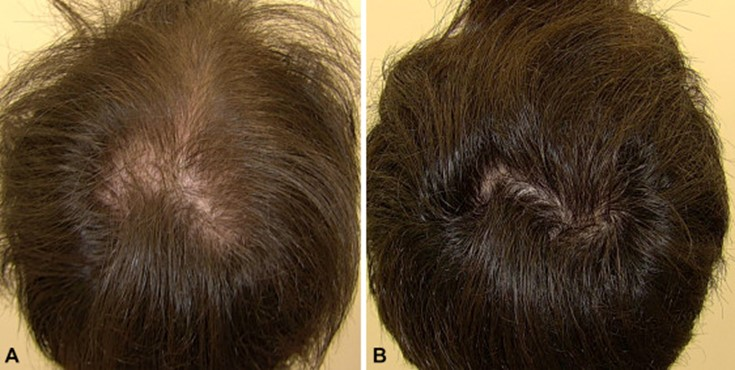 AADmember's tweet photo. “Recently, there have been multiple studies exploring the use of low-dose oral minoxidil (< 5mg daily) for treating many forms of alopecia, with the goal of gaining hair while keeping adverse reactions at bay. #DermWorld Insights and Inquiries https://t.co/Md0ddMTM5K #dermtwitter https://t.co/oEYASpNFKV