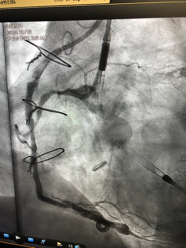 KeithNguyenSAIF's tweet photo. Protected pci double cto intervention to lcx and rca. Retrograde via svg.  Laser and shockwave. @SAIFSanAntonio https://t.co/VidfRksz7T