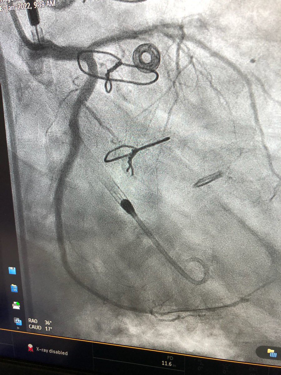 KeithNguyenSAIF's tweet photo. Protected pci double cto intervention to lcx and rca. Retrograde via svg.  Laser and shockwave. @SAIFSanAntonio https://t.co/VidfRksz7T