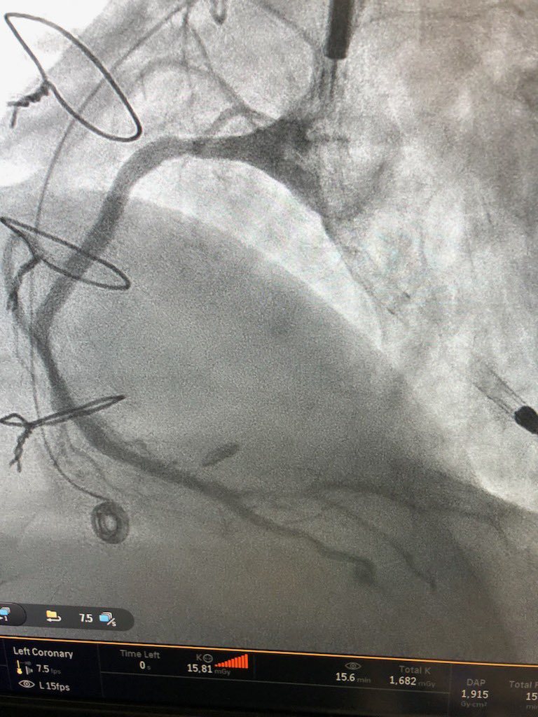 KeithNguyenSAIF's tweet photo. Protected pci double cto intervention to lcx and rca. Retrograde via svg.  Laser and shockwave. @SAIFSanAntonio https://t.co/VidfRksz7T