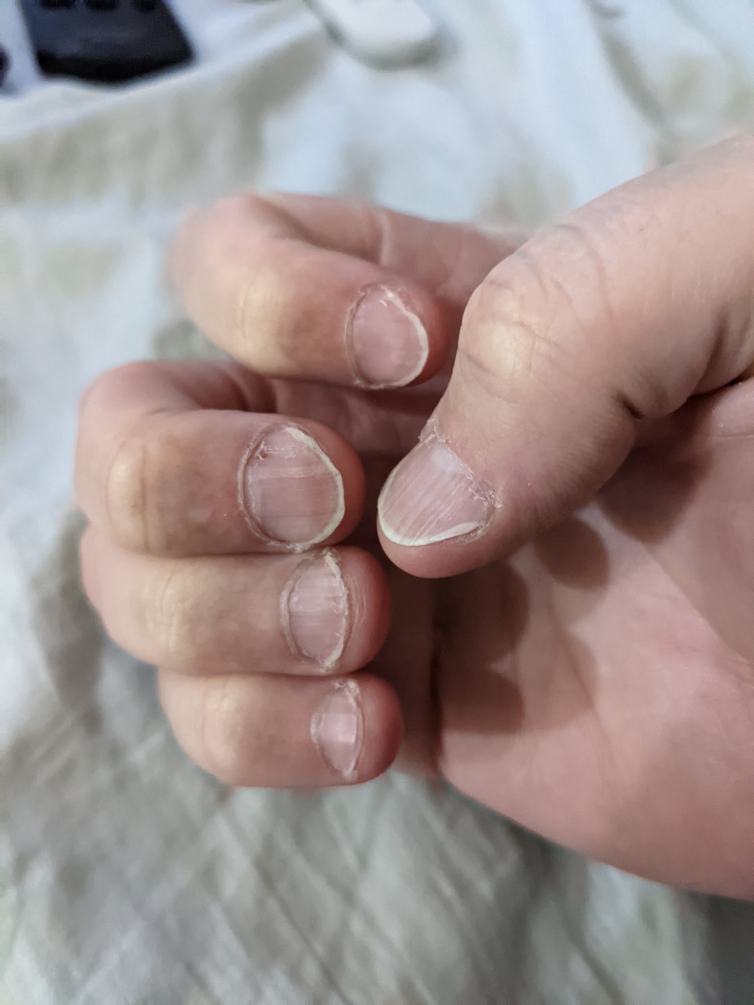 The Ultimate Guide To Onychophagia: Is Nail Biting Self Harm? - Dr. Ori