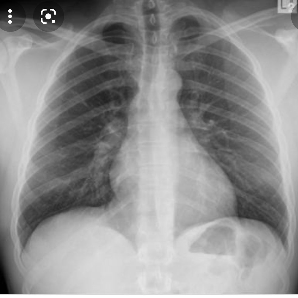 Radiology Twitter Tweet: - Align Medial sagittal plane to midline of cassette. - Ensure no rotation of thorax.
- Top of film 4-5 cm above shoulders.
- Place caste crosswise to avoid lateral cutoff.
- Make exposure at end of second full inspiration.
#Radiology_study #XRAY #Chest #Radiograph https://t.co/u3XCwknDuo