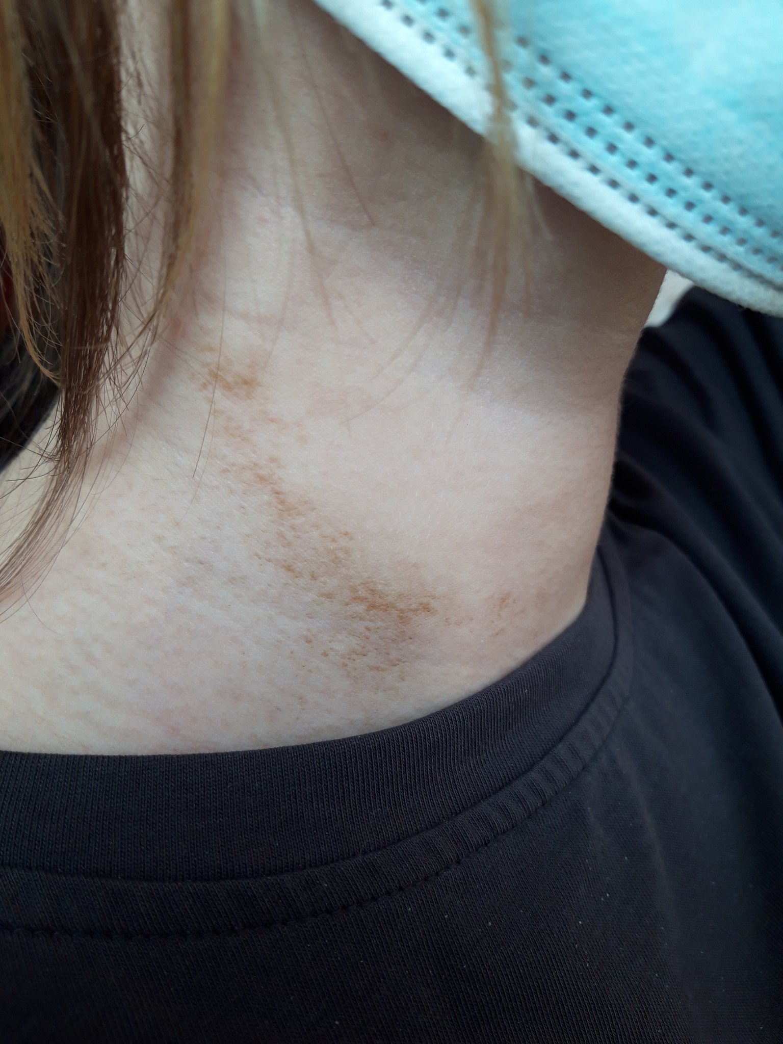 Doc Holiday on Twitter: "Patiente de 15 ans présentant ce type de lésions  sèches pigmentées à la face antérieure du cou.. C'est ça un acanthosis  nigricans #DocTocToc ? https://t.co/L25SShcE08" / Twitter
