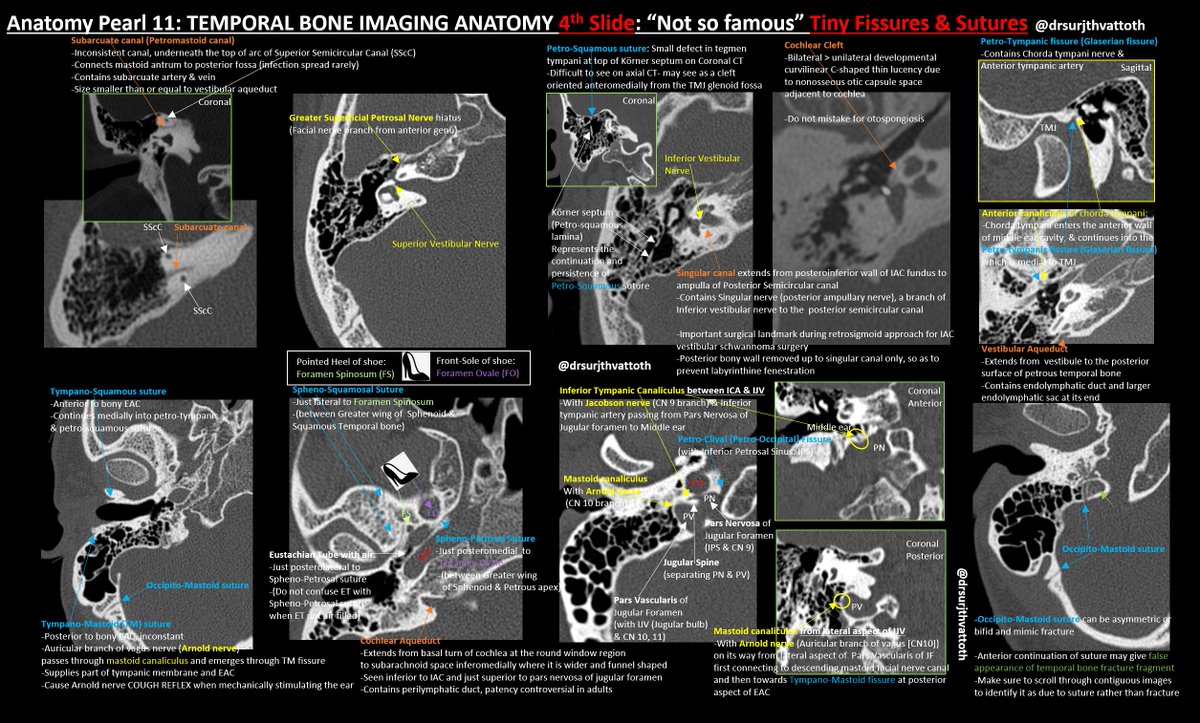 Anatomy Pearl 11: TEMPORAL BONE IMAGING ANATOMY 4th Slide: “Not so famous” Tiny Fissures &amp; Sutures

Be familiar with these not well known normal anatomical lucent lines- can be FRACTURE MIMICS 

#neurorad #radres #neurosurgery #neurology #FOAMed #Foamrad #Anatomy #otolaryngology