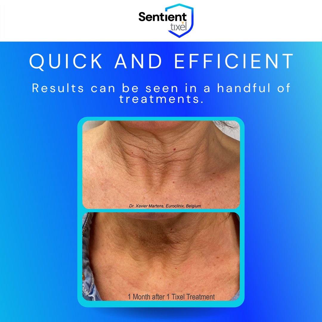 Sentient_Lasers's tweet image. Before and after photoset of the Sentient Tixel™ after one treatment. Those are some amazing results! 

wwww.sentientlasers.com/tixel

#confidenceassured #sentientlasers #sentienttixel #aesthetic #aestheticdoctor