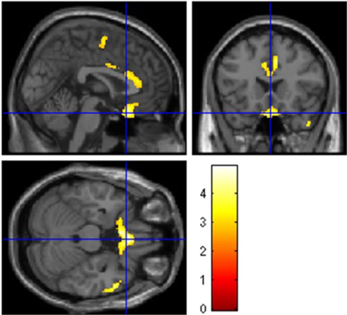 Jerome_Larche's tweet photo. HYPOMETABOLISME CEREBRAL et ANOSMIE POST-COVID #CovidLong #TEPSCAN
Hyposmie post-#Covid associée à un dysfonctionnement dans les régions corticales impliquées dans perception olfactive ou avec régions interconnectées avec cortex olfactif primaire.
https://t.co/OWsomd7DKK https://t.co/YMEQ6ImLuY