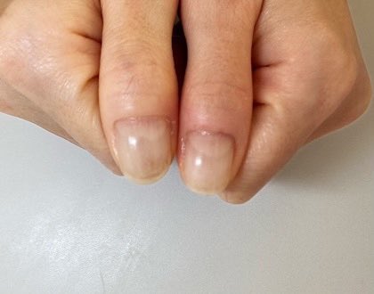 深爪矯正サロン ハンドとフット爪の長さだし 下北沢自爪育成ネイルサロン 爪の凸凹 なおりました 深爪 長さだし 爪の凸凹 でこぼこ爪 爪育成 ネイルサロンアリューム 東京都世田谷区北沢3 11 グレース北沢1 ホームページ T Co