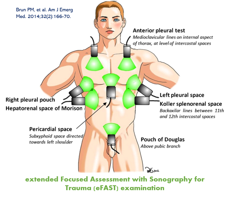 Focused assessment with sonography for trauma - Wikipedia