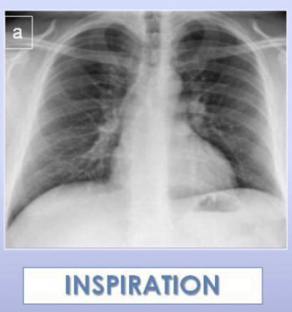 Radiology Twitter Tweet: Effect of inspiration/expiration of chest radiography:
-If 6 Anterior or 10 posterior ribs are visible then the patient has taken an adequate inspiration effort.
-Conversely, fewer than 6 Anterior ribs implies a poor inspiratory effort
#Radiology_study #Xray #chest #radiology https://t.co/whznKqrCMk