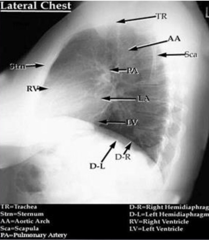 Radiology Twitter Tweet: Lateral chest radiography
#anatomy #radiograph #chest #xray #Radiology #Radiology_study https://t.co/YLy7B7jbBX