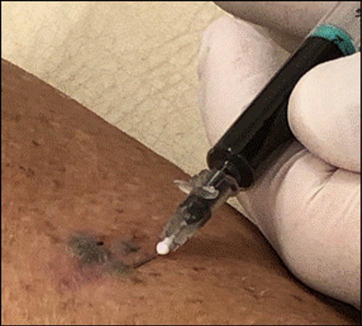OlofssonBagge's tweet photo. We used a low dose between 0.02–0.5 mL of superparamagnetic iron oxide (SPIO) #MagTrace injected intracutaneously around the excision scar. https://t.co/dILdNqtA0f