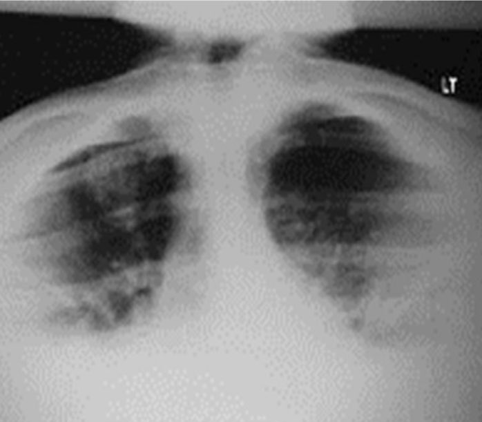 Radiology Twitter Tweet: For example:
Apical Chest projection demonstrating TB in the right apex:
#Xray #Radiology_study #radiology #chest #pathology #TB https://t.co/B7OOiqvXek