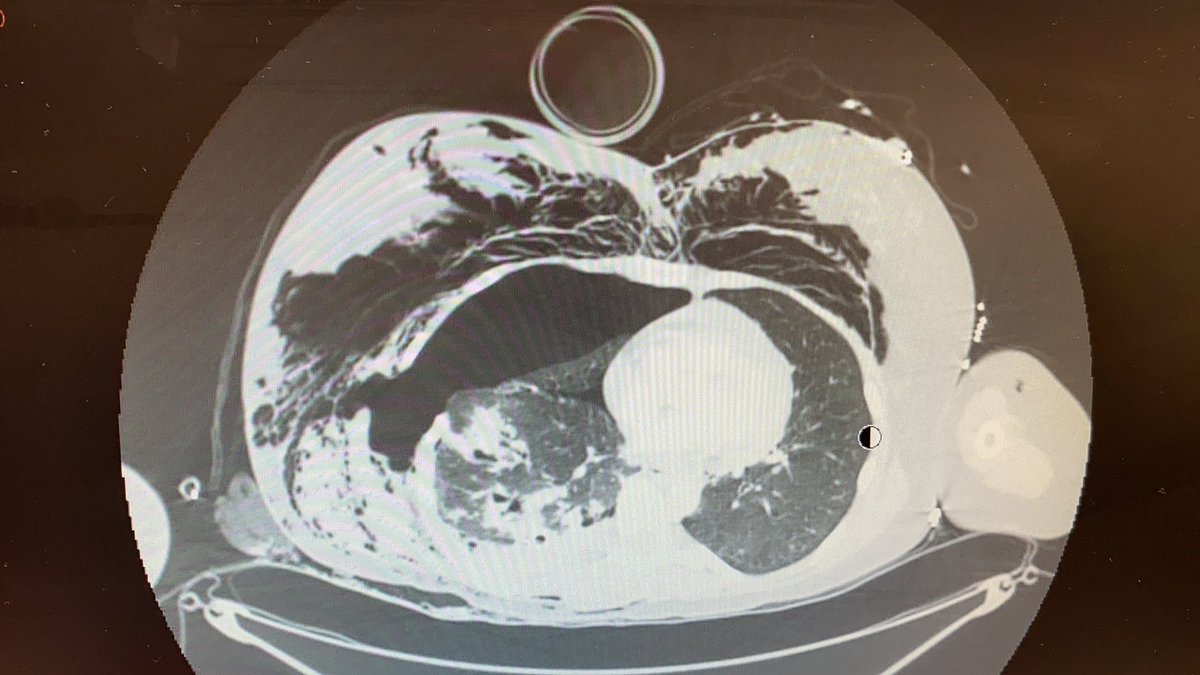 mataixponce's tweet photo. Woman, 60 years old, who suffers a fall while riding a horse receiving a strong impact on her chest. It begins with a respiratory failure clinic that ends in cardiac arrest. What is a possible cause? #ICU #Trauma #emergency https://t.co/3Rbqjoa9vZ