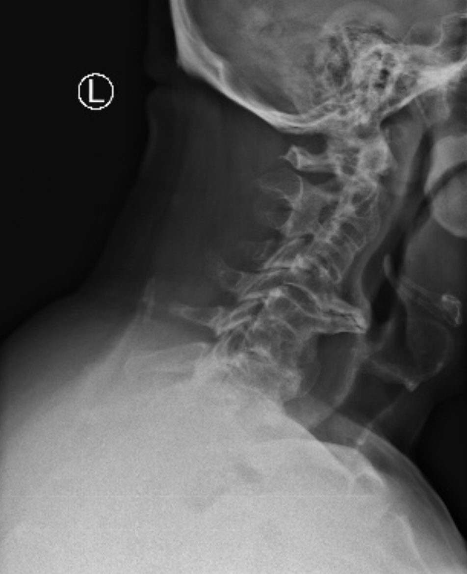 DaniloSilvaMD's tweet photo. “Doc, I can’t swallow and have difficulty breathing.What does that have to do with my spine ?”
🤔😳#spinesurgery #spine #medicine https://t.co/ofHyzIylvW