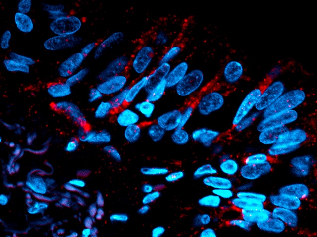 Biomedical Picture of the Day BPoD (@bpod_s) on Twitter photo Elevated #microRNA 21 underlies #COPD - reducing it reduces symptoms. Image and research by <a href="/DrRichardYKim/">Dr Richard Kim</a>, Krishna P. Sunkara, <a href="/BrackeKen/">Ken Bracke</a> & Andrew G. Jarnicki et al <a href="/HansbroResearch/">Hansbro Research</a> <a href="/CentenaryInst/">Centenary Institute</a> in <a href="/ScienceTM/">Science Translational Medicine</a>. More on bpod.mrc.ac.uk/archive/2022/1… with <a href="/MRC_LMS/">MRC Laboratory of Medical Sciences (LMS)</a> & <a href="/AntDLewis/">Ant Lewis</a> Elevated #microRNA 21 underlies #COPD - reducing it reduces symptoms. Image and research by <a href="/DrRichardYKim/">Dr Richard Kim</a>, Krishna P. Sunkara, <a href="/BrackeKen/">Ken Bracke</a> & Andrew G. Jarnicki et al <a href="/HansbroResearch/">Hansbro Research</a> <a href="/CentenaryInst/">Centenary Institute</a> in <a href="/ScienceTM/">Science Translational Medicine</a>. More on bpod.mrc.ac.uk/archive/2022/1… with <a href="/MRC_LMS/">MRC Laboratory of Medical Sciences (LMS)</a> & <a href="/AntDLewis/">Ant Lewis</a>