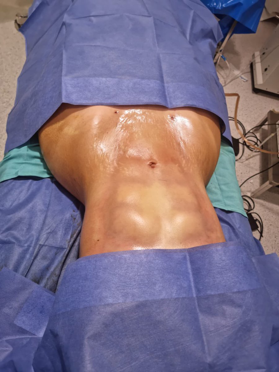 ايه رأيكم هل تفضلو نحت الجسم عالى التحديد بطريقة تحسين فور دي للسيدات بإظهار الشكل العضلى لعضلات البطن والا لا؟  #tahseen4d